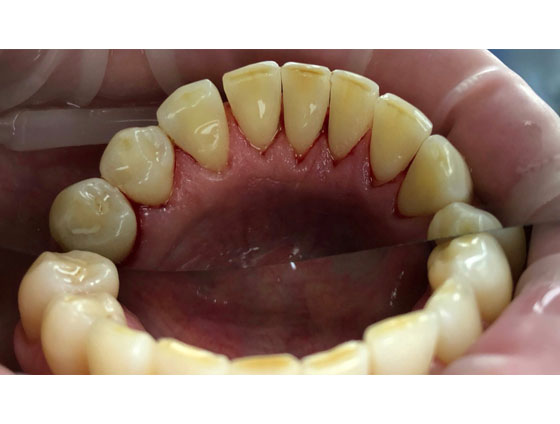 Після професійної гігієни
