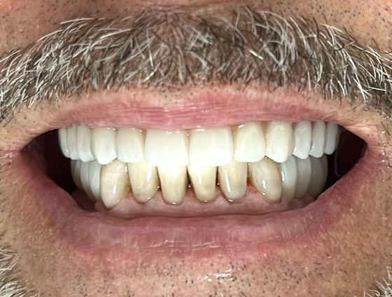 Після імплантації зубів