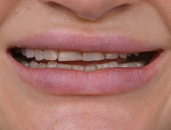 До встановлення керамічних вінірів – кейс 1