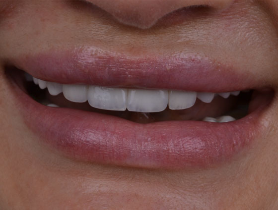 Після встановлення керамічних вінірів – кейс 1