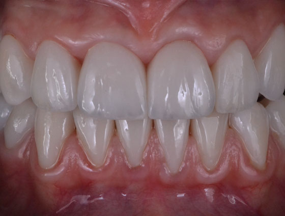 Після встановлення керамічних вінірів – кейс 2