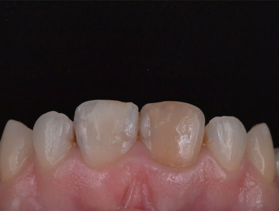 До комплексної реабілітації усмішки – кейс 3