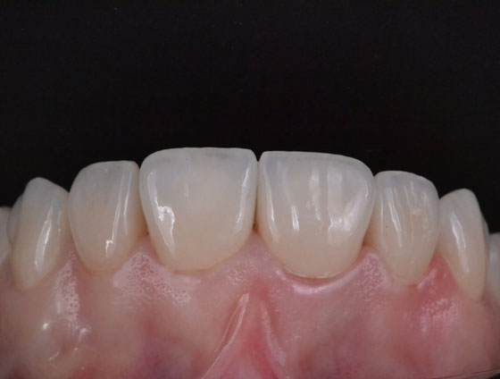 Після комплексної реабілітації усмішки – кейс 3