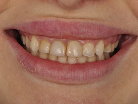 До встановлення керамічних вінірів