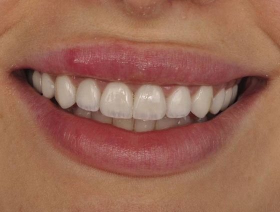 Після встановлення керамічних вінірів