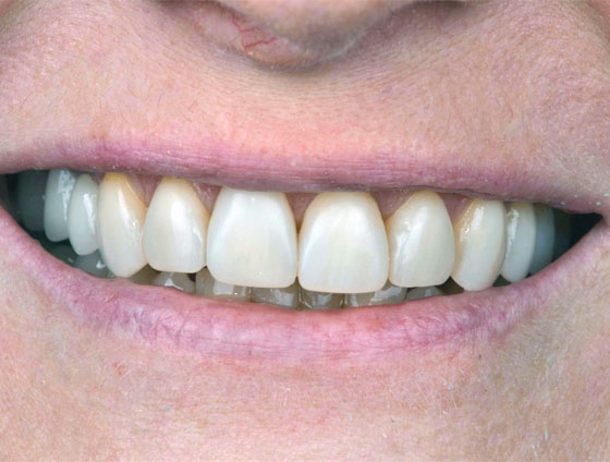 До встановлення керамічних вінірів – кейс 5