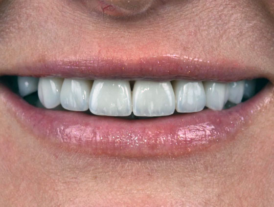 Після встановлення керамічних вінірів – кейс 5