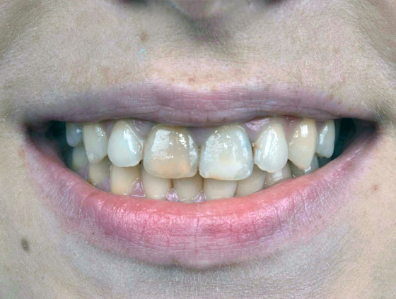 До естетичної реабілітації керамічними вінірами – кейс 6