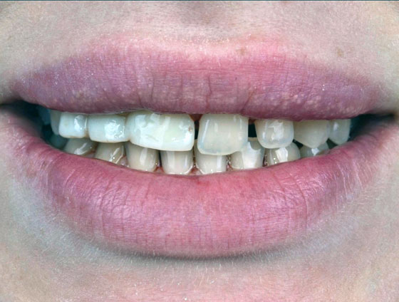 До комплексної реабілітації усмішки – кейс 7