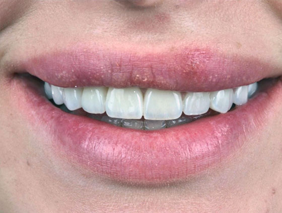 Після комплексної реабілітації усмішки – кейс 7