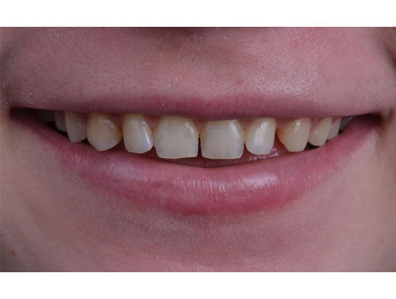 До композитних вінірів