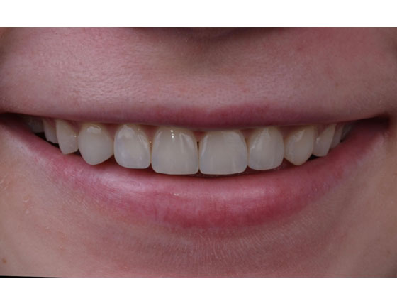 Після композитних вінірів