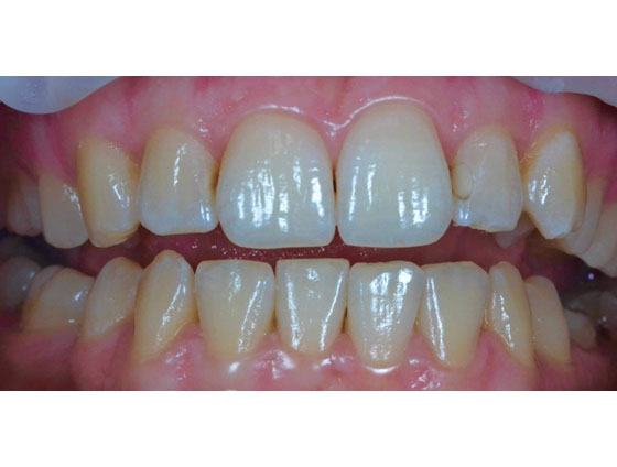 До відбілювання зубів