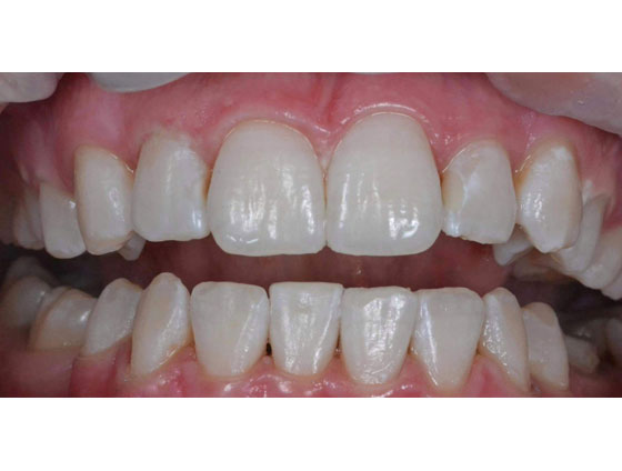 Після відбілювання зубів