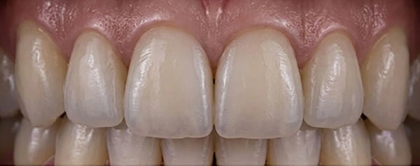 Кераміка E-max Press